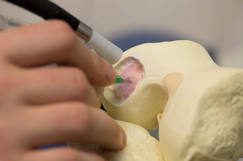 surgeons 3D print stem cells and repair bone with biopen - 1