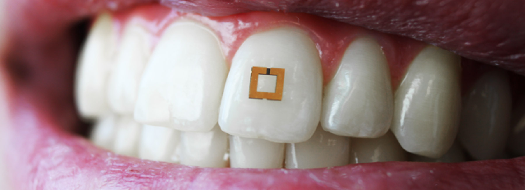 scientists developed a golden sticker for your tooth to track how much you eat