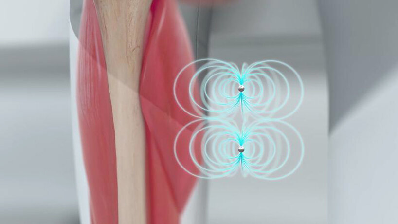 MIT discovers tiny magnetic beads that help control prosthetic limbs better